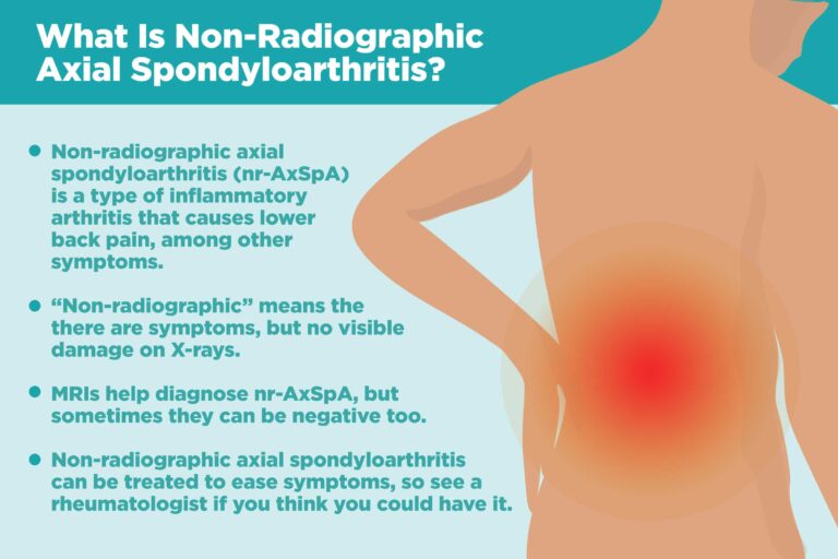 Non-Radiographic Axial Spondyloarthritis: What Is It, and How Is It Treated?