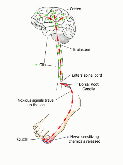 What Causes Fibromyalgia? & Why So Many Symptoms