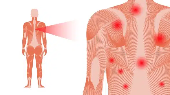 Fibromyalgia Symptoms, Causes & Personalised Treatment
