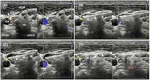 Adjunctive ultrasound-guided vagus nerve-targeted pharmacopuncture for refractory fibromyalgia with autonomic symptoms: a case report