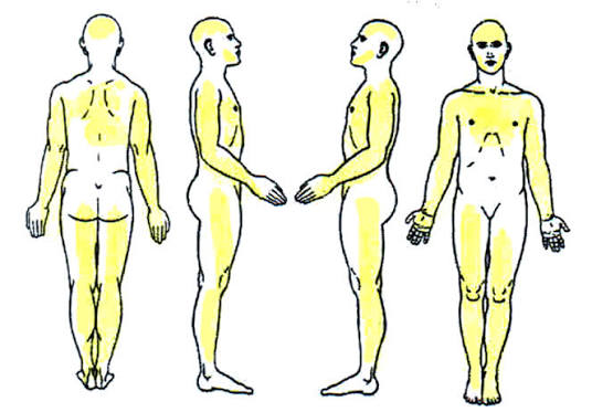 Low-Dose Naltrexone for Severe Fibromyalgia Syndrome: A Report of a Case With Two-Year Follow-Up