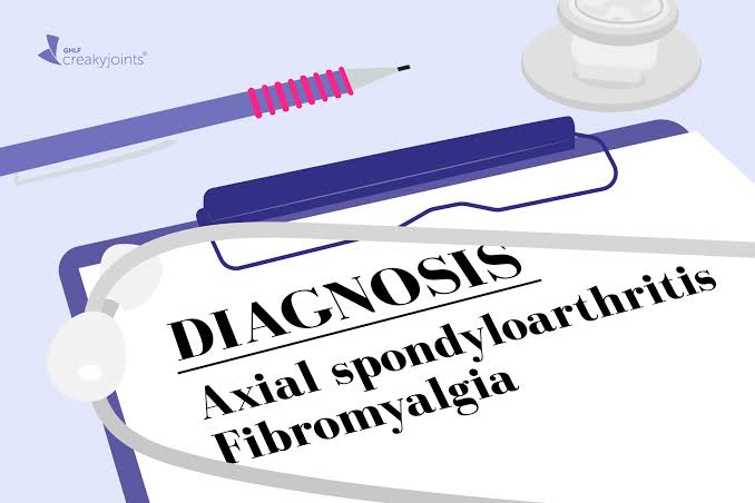 Which Axial Spondyloarthritis Patients Are More Likely to Develop or Recover from Fibromyalgia? What a New Study Found
