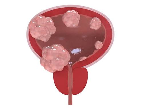 FDA Issues Refusal to File Letter for Axsome’s Novel Fibromyalgia Candidate